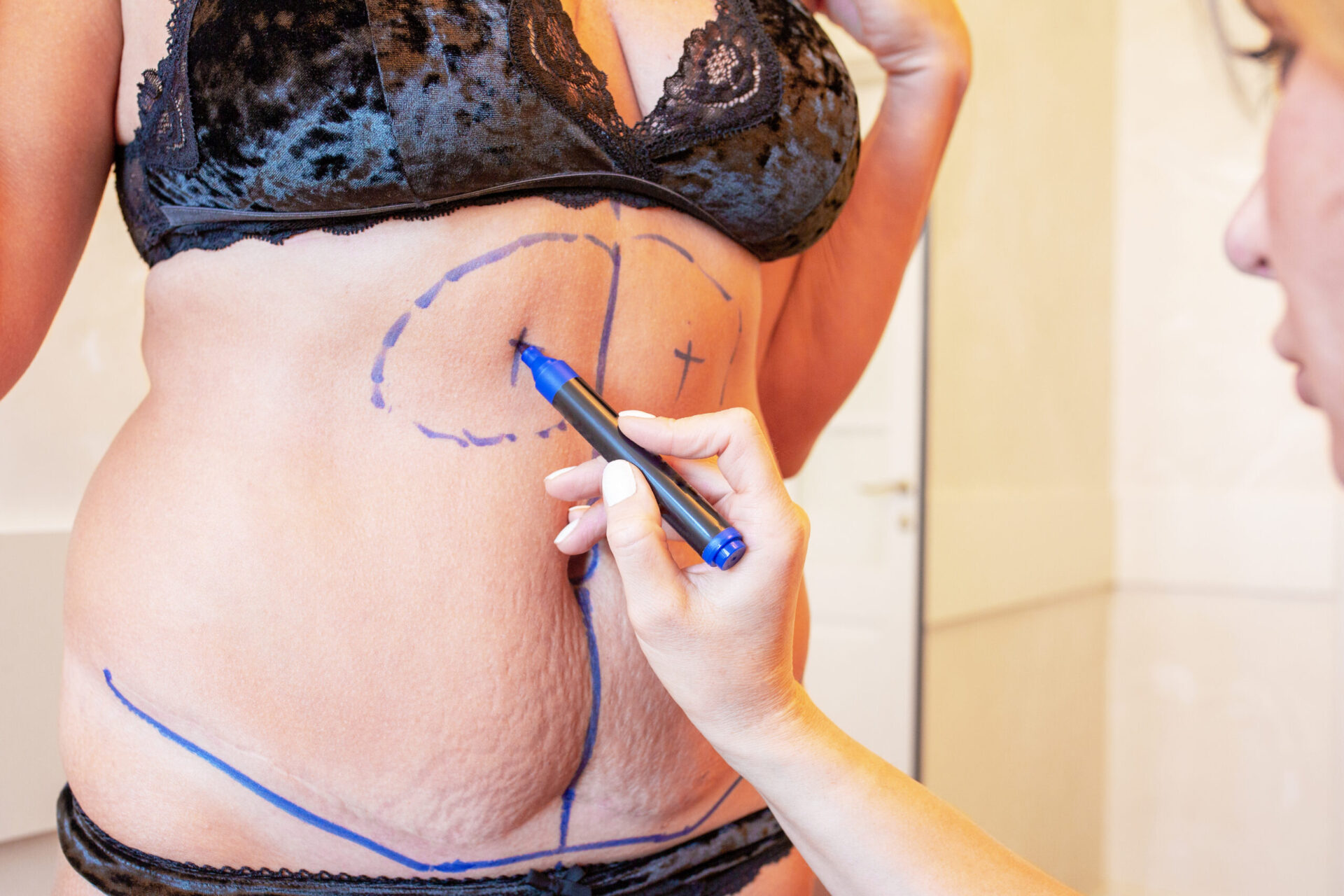 Lipoaspiração: tipos e procedimentos